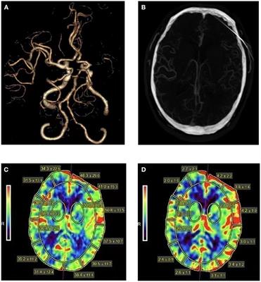 Evaluation of collateral status and outcome in patients with middle cerebral artery stenosis in late time window by CT perfusion imaging